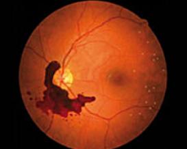 Diabetic retinopathy - diabetics at risk!1