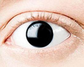 Aniridia - incomplete or missing iris1