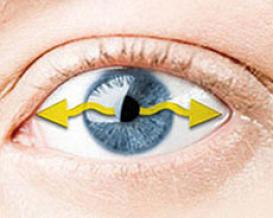 Nystagmus - involuntary rapid eye movements1