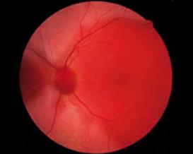 Ocular albinism – lack of retinal pigment cells1
